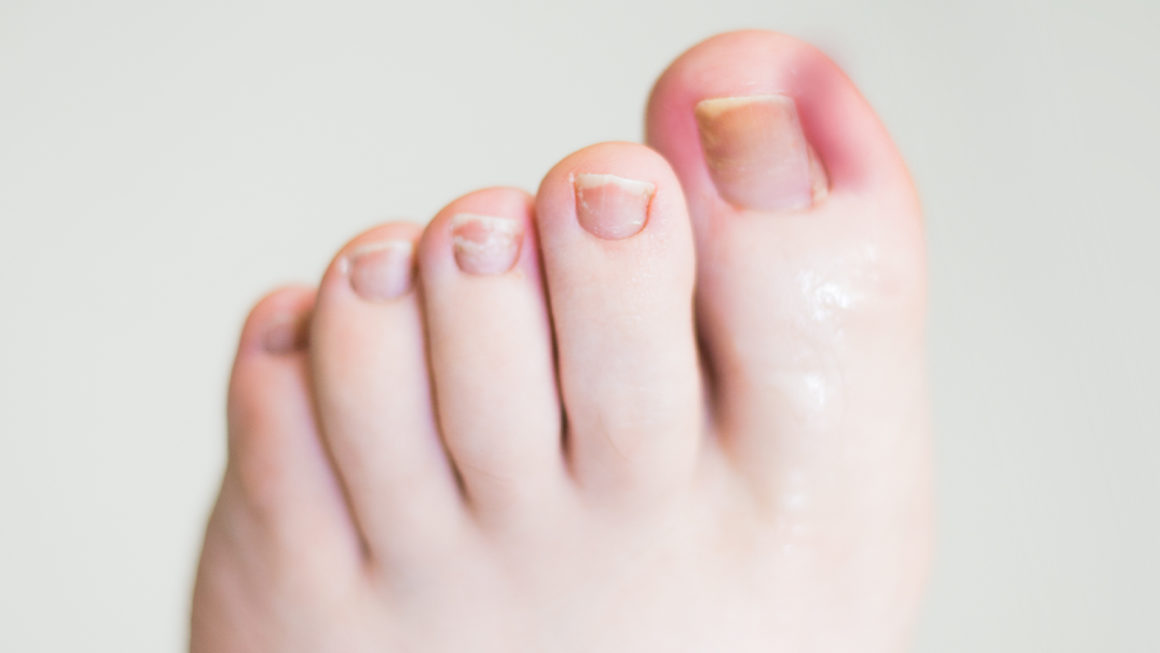 Ingrown toenails