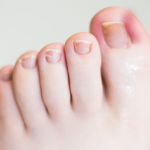 Ingrown toenails