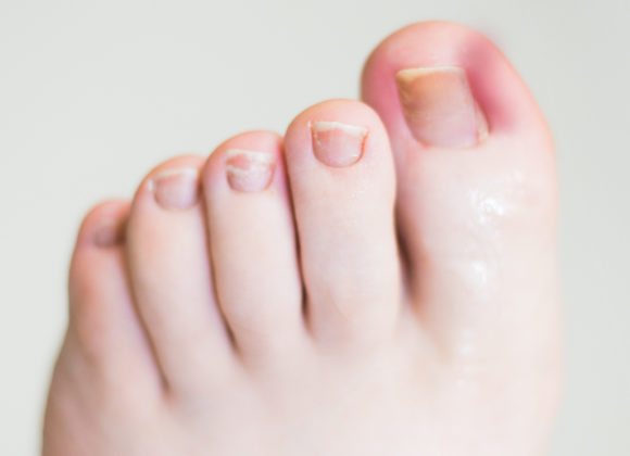 Ingrown toenails